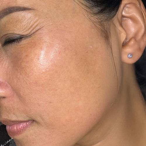 Después del tratamiento