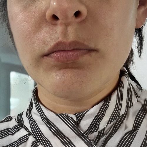 Después del tratamiento