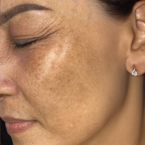 Antes del tratamiento